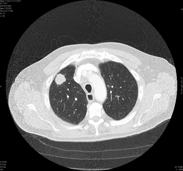 Screenings Aid in Early Lung Cancer Detection | Bluegrass Regional Imaging