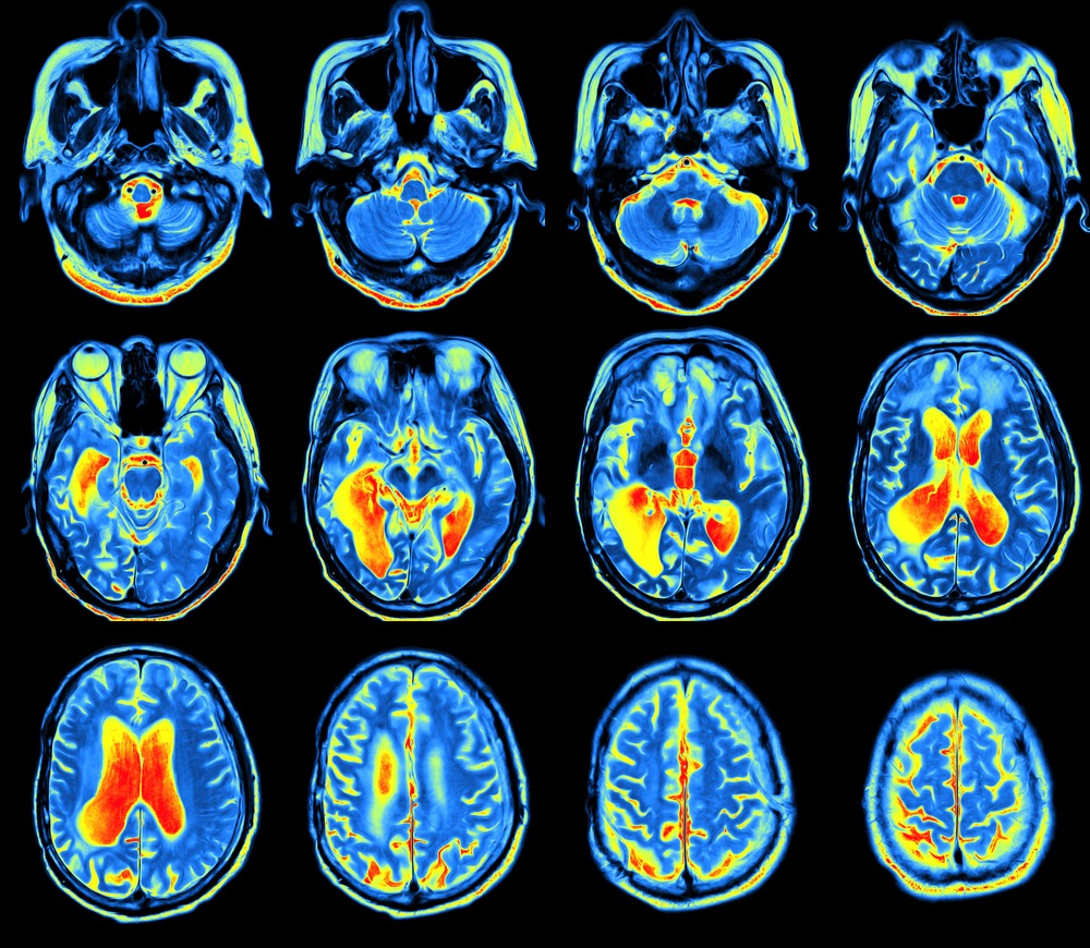 FDG PET Scan More Accurately Assesses Severity Of Cognitive Decline In 